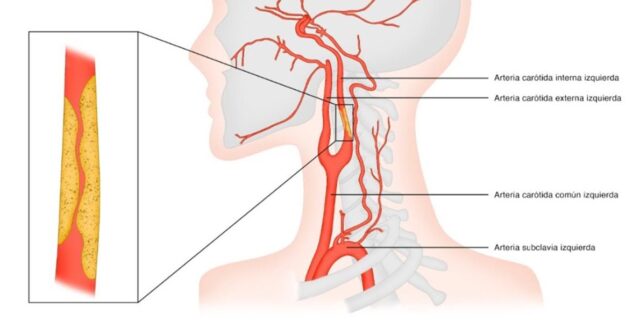 Estenosis_carotidea-1x1.jpg